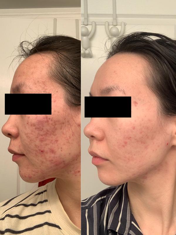 Miracle toner! One of the best products from the Vinopure line for me.