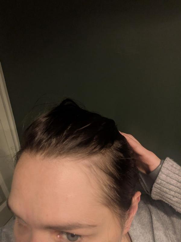 Mehr Volumen bei beginnenden Haarausfall