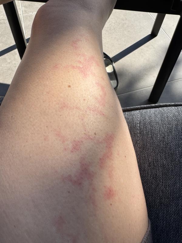 Allergie exposition solu