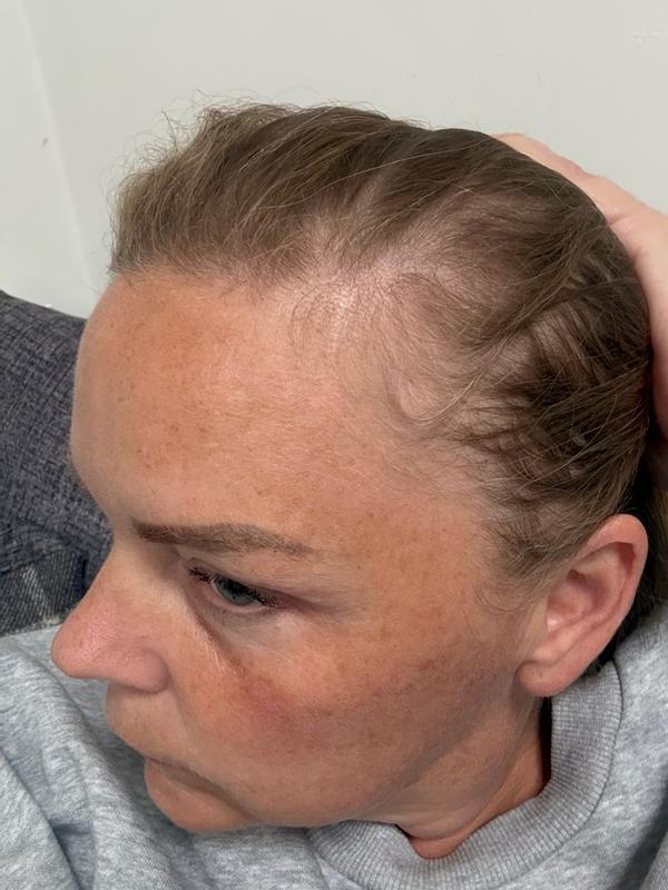 Beautiful hair loss serum