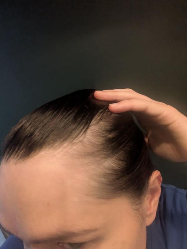 Mehr Volumen bei beginnenden Haarausfall