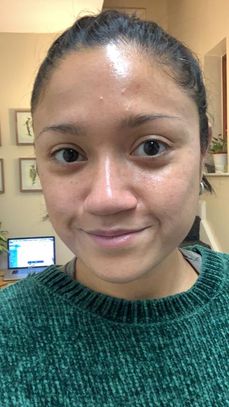 ultrasun pigmentation