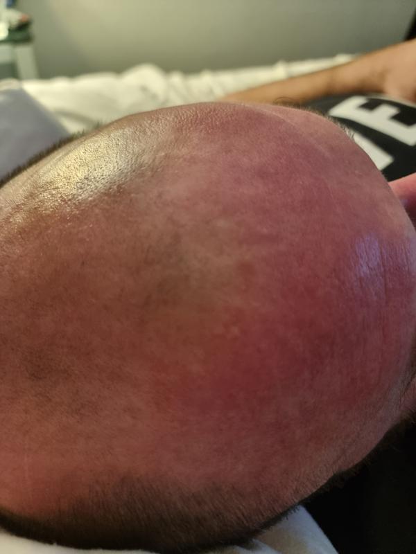 Reaction on skin came out after 1 hour