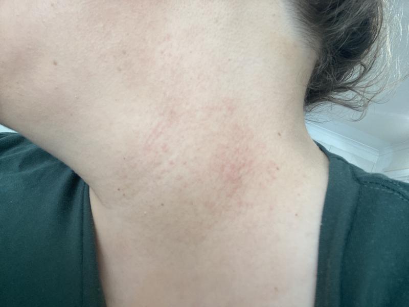 Beginnings of rash