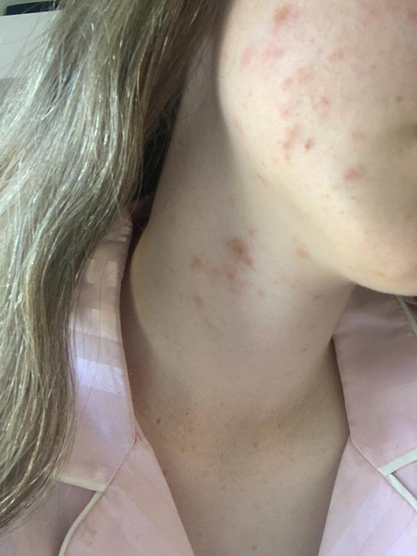 The rash it left me