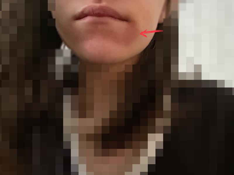 Burns I got from using the product