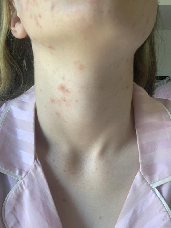 All over my face and neck