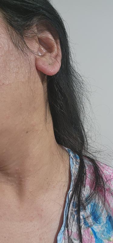 Abrasions and rashes