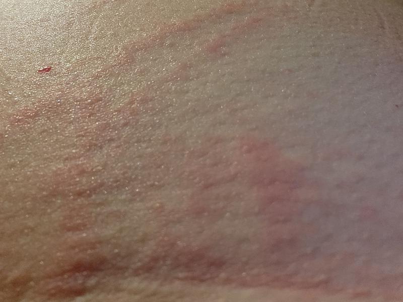 Just 2 of the rash & it it caused me