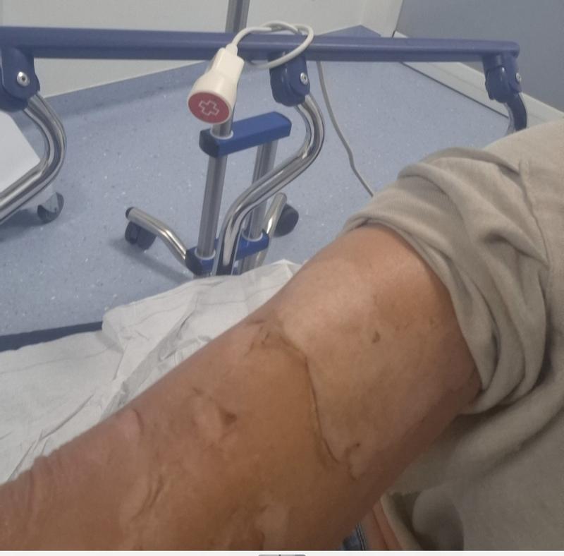 Nach der Verwendung im Notfall da sich die komplette Haut abschält,dazu ein höllischer Juckreiz