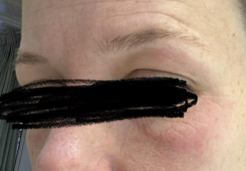 Gerötete Haut ums Auge