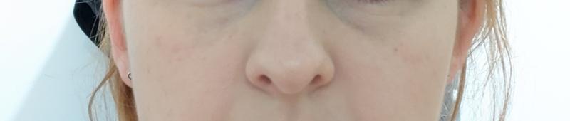 Nachher
