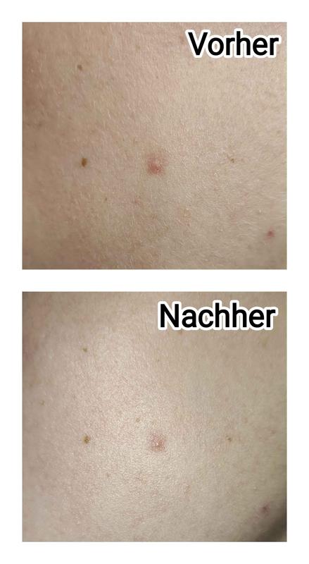 Garnier Hautklar Pimple Patches