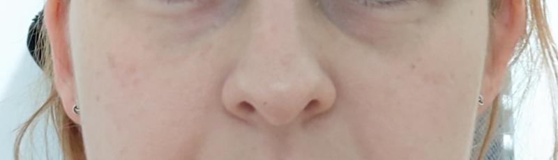 Vorher