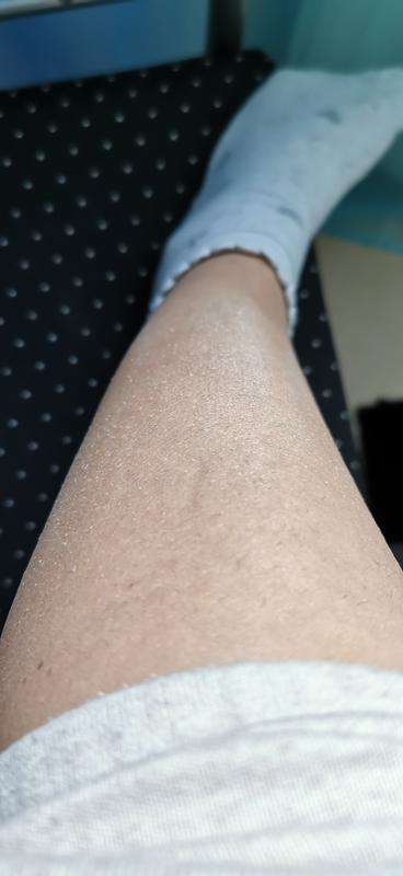 Vorher, meine trockenen Haut