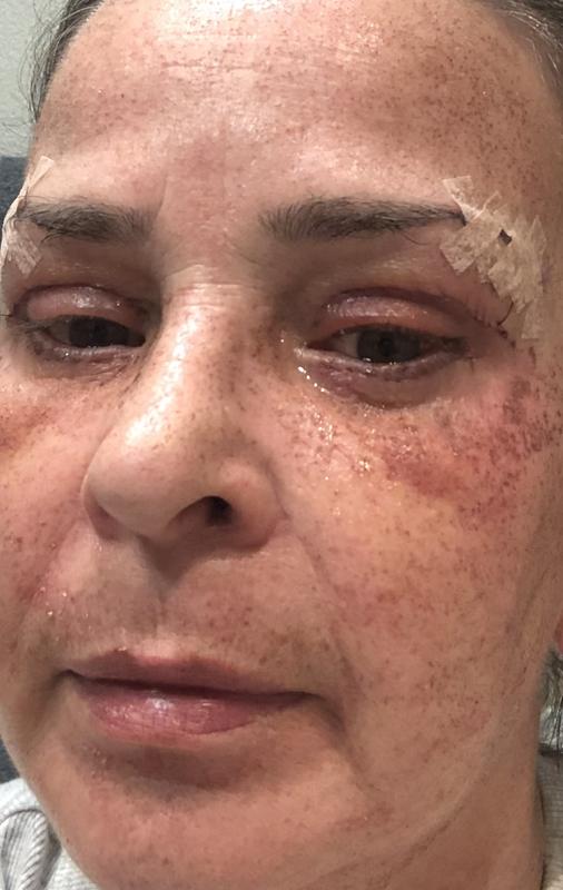 My skin after laser