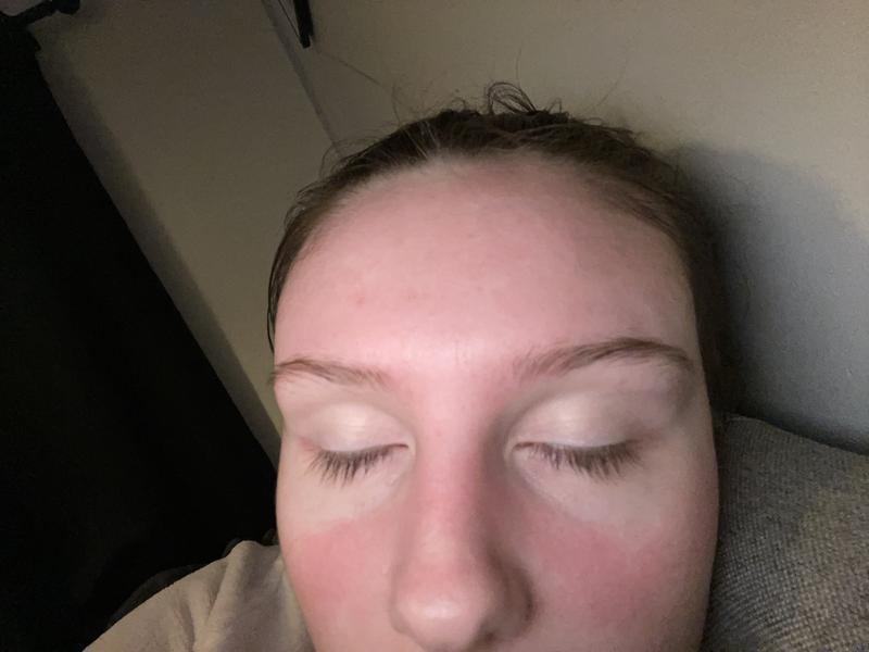 BURNT