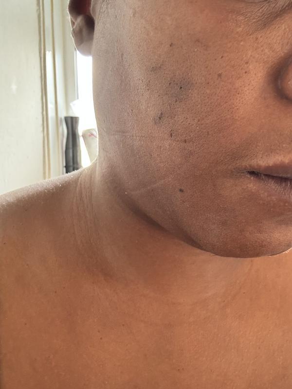 Scars and dark marks almost gone