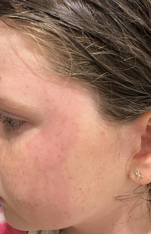 Rash visible where shampoo trickled down in shower