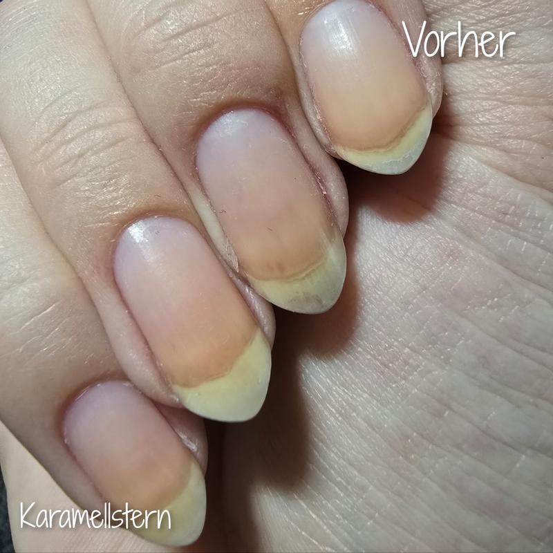 Vorher