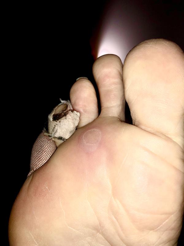 Applied balm, but got this little Beauty after 13k.