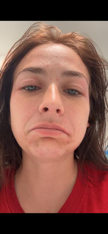Eyelids
