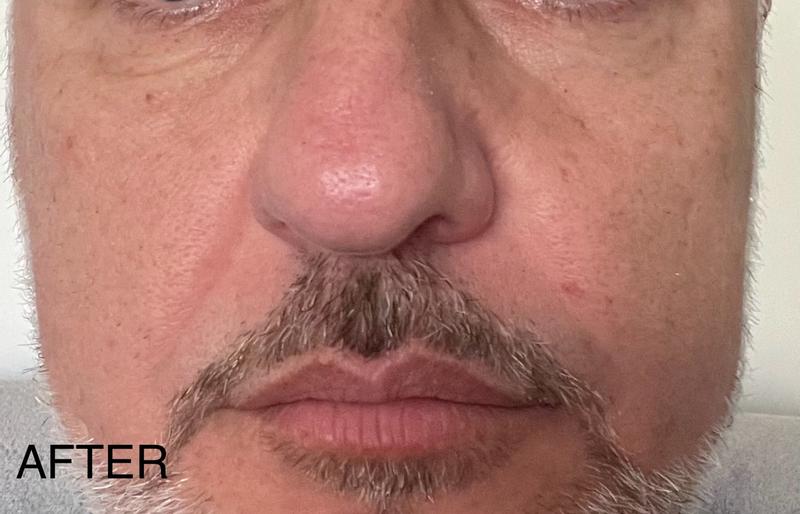 After photo of face