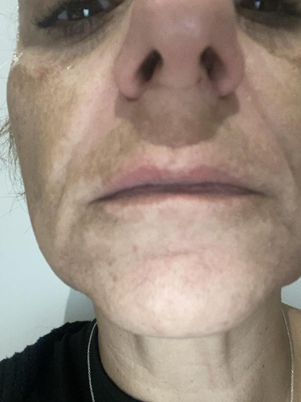 My upper lip after 2 weeks of using