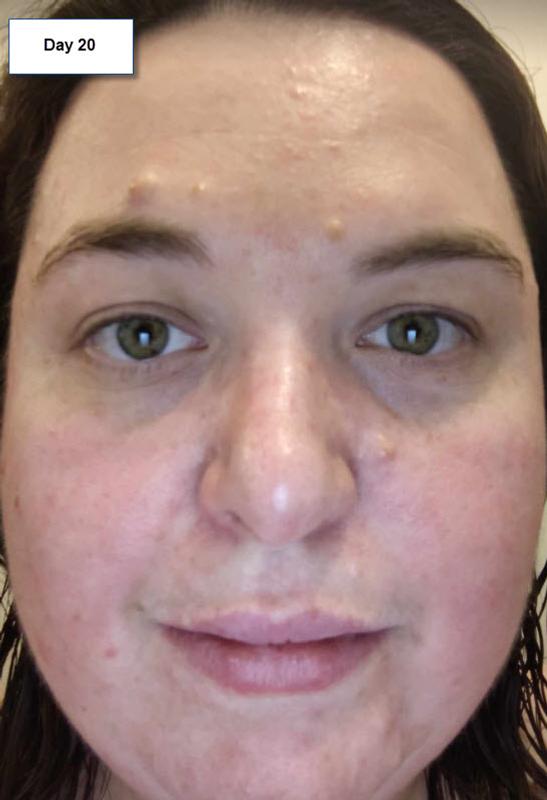 Burnt face and skin peeling from this product.