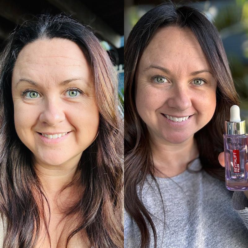 Before and After using L�Oreal Revitalift Filler