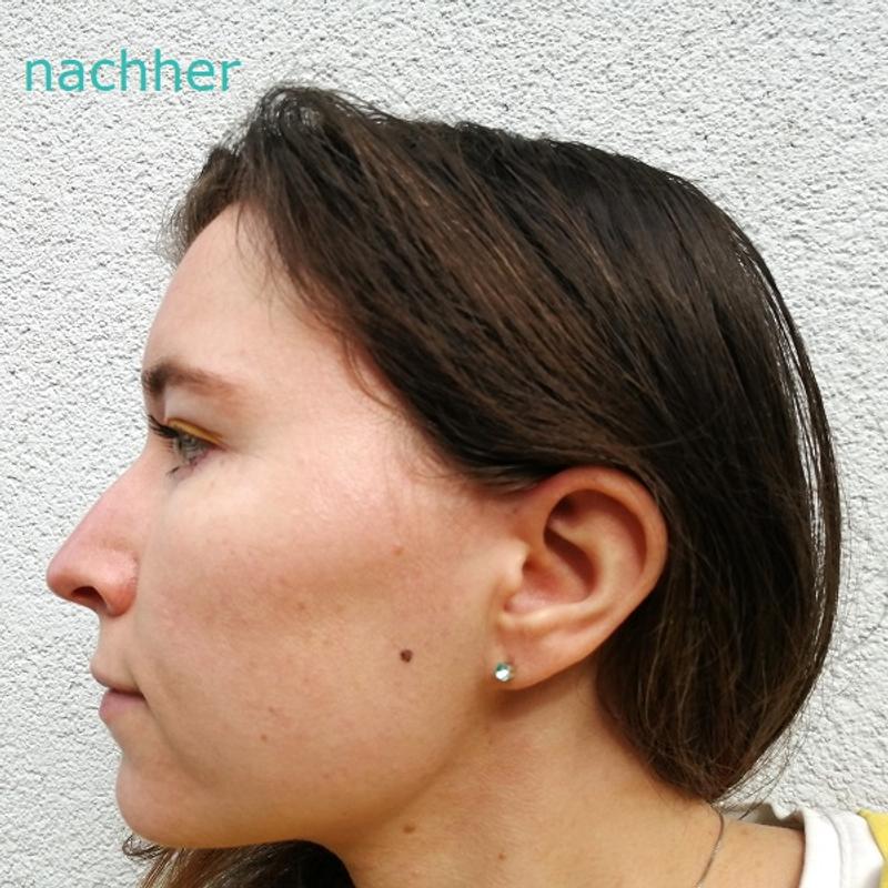 [Werbung] L’ORÉAL Paris Bright Reveal Niacinamid Dark Spot Serum Haut nachher