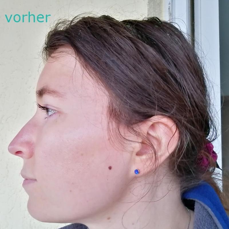[Werbung] L’ORÉAL Paris Bright Reveal Niacinamid Dark Spot Serum Haut vorher