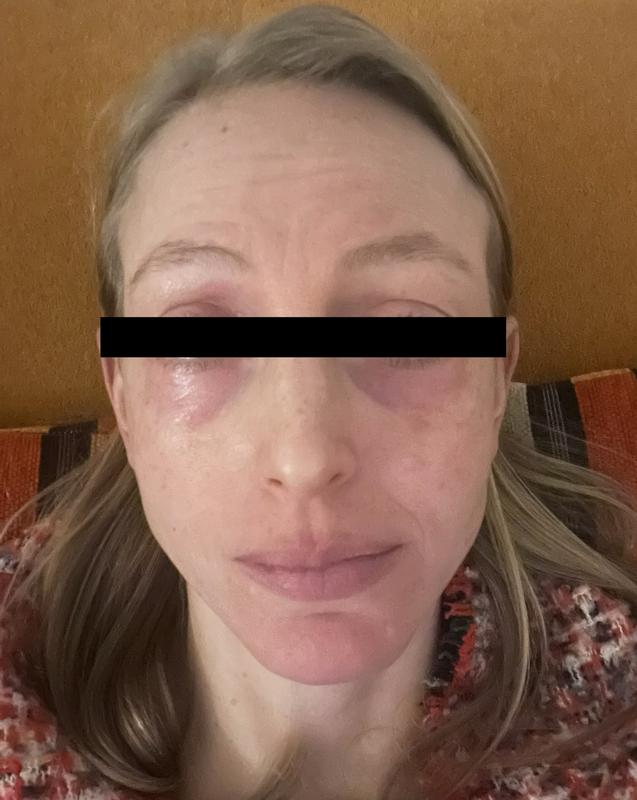 1. Tag nach der Anwendung