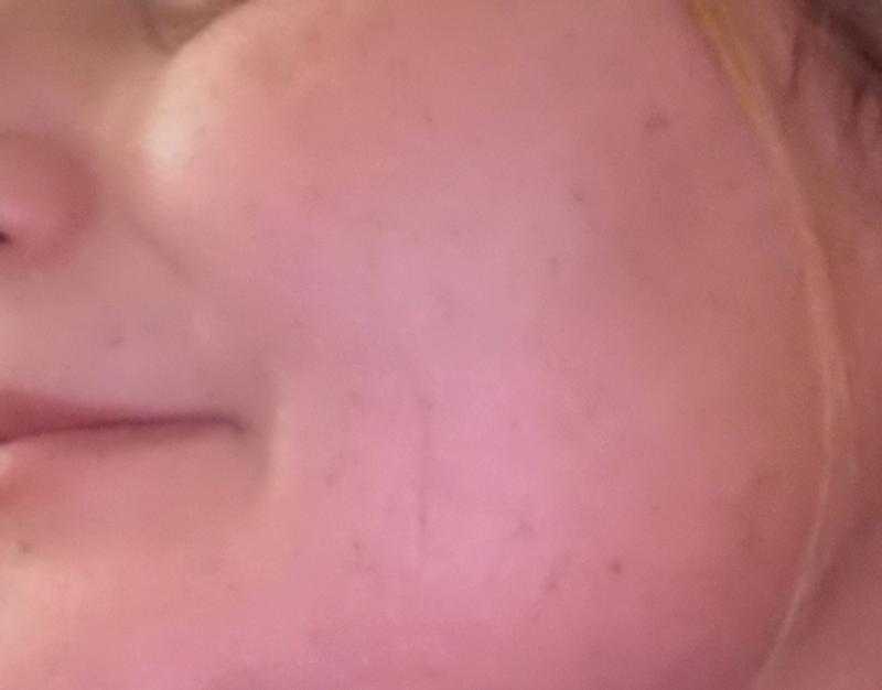 Vorher