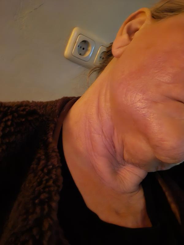 Mijn nieuwe rode jeukende huid