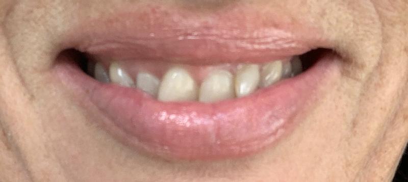 After one light application