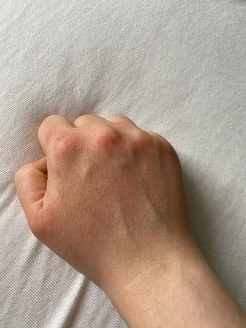 wunde haut- vor allem zwischen finger und mittelhandbereich
