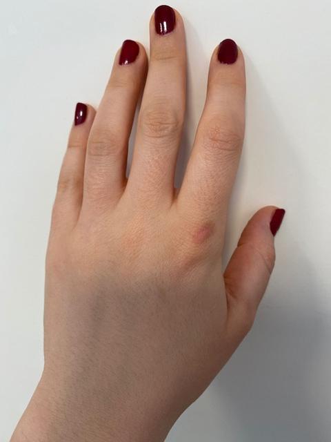 linke hand: geheilte wunde (zuvor offene stelle)
