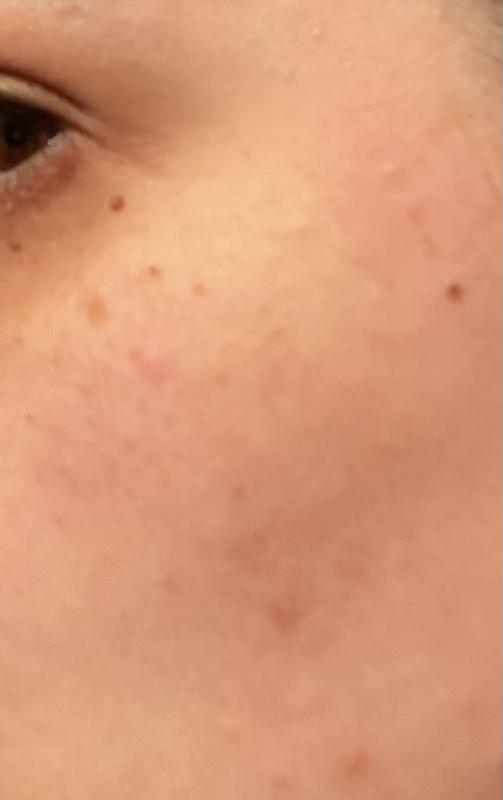 la foto delle macchie rosse non rende :(ma era molto rosso e prudeva