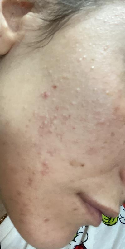 Risultato dopo 1 mese