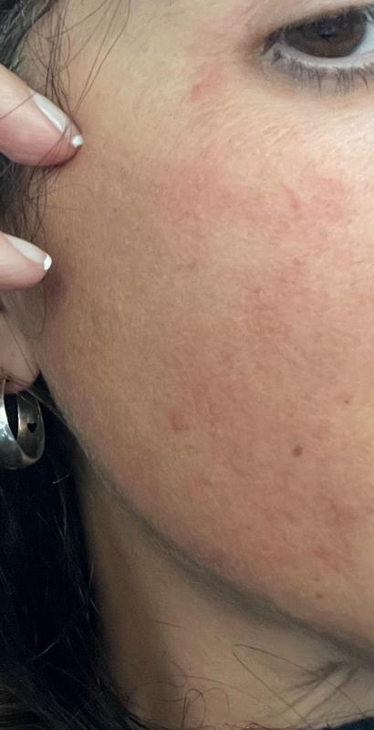 Orticaria allergica