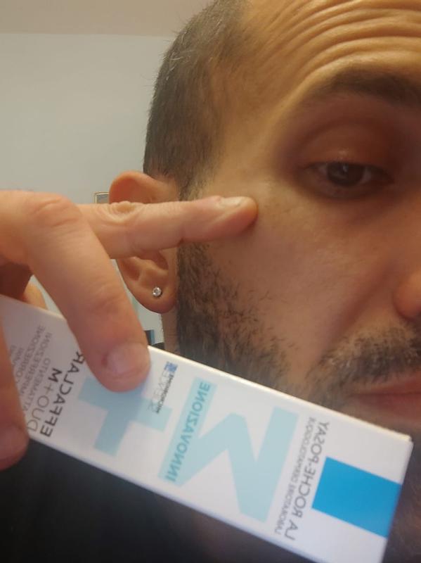 La mia macchia indicata sotto l'occhio e schiarita ed i punti neri sul naso