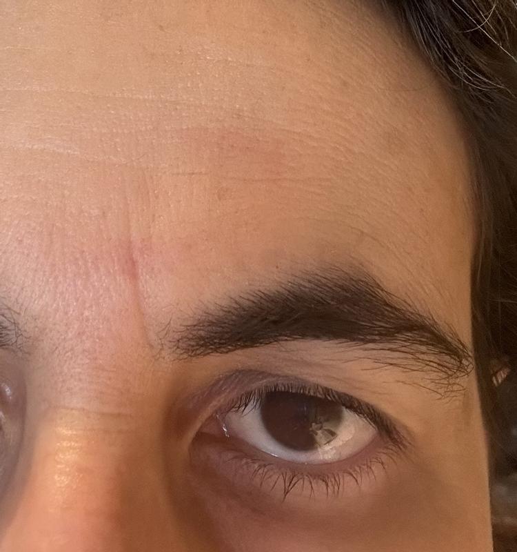 i rossori dopo la microabrasione (anche le macchie e rughestano comparendo e vo crei capire se svaniranno)