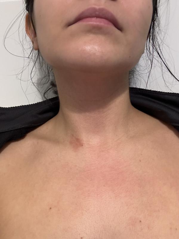 Prima - pelle molto irritata per la secchezza
