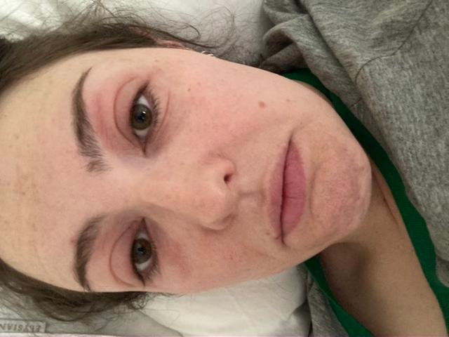 Allergic reaction