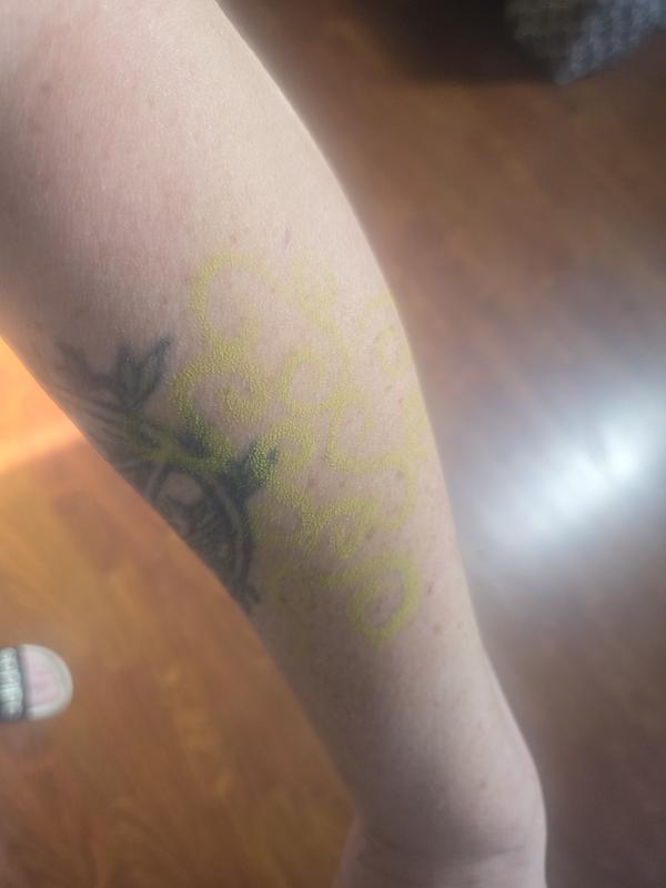 3 days after application to arm.