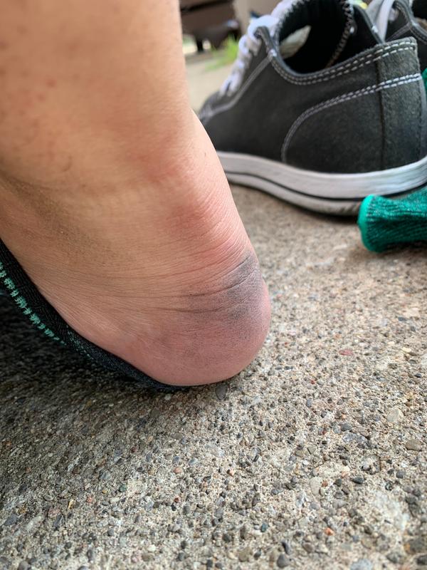 The back of my foot is bruised, very red and in intense pain