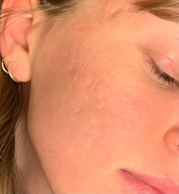 murad blemish control invisiscar resurfacing treatment