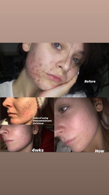 murad blemish control invisiscar resurfacing treatment