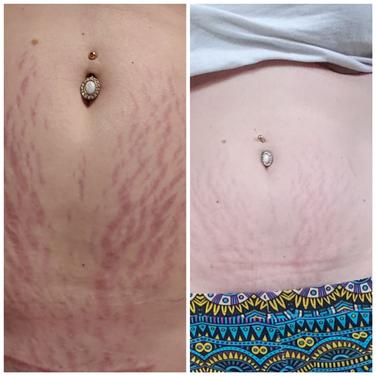 b flat stretch mark cream